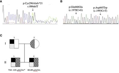 Case Report: Functional Analysis and Neuropsychological Evaluation of Dyshormonogenetic Fetal Goiter in Siblings Caused by Novel Compound Hyterozygous TPO Gene Mutations